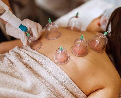 Cupping Massage Therapy at Markham clinic